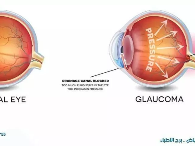 The Impact of Allergies on Ocular Hypertension and Eye Health