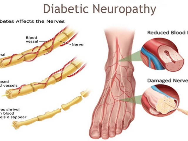 The Impact of Vidagliptin on Diabetes-Related Nerve Pain